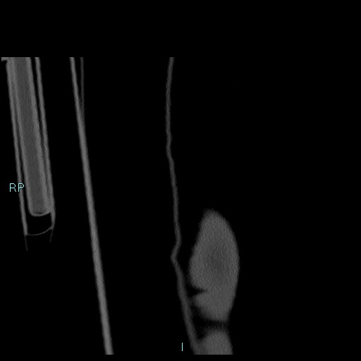 Avascular necrosis after fracture dislocations of the proximal humerus (Radiopaedia 88078-104655 Coronal bone window 3).jpg