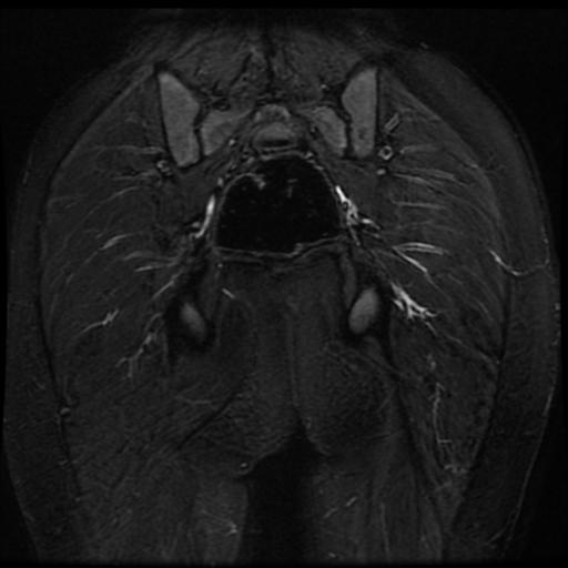 File:Avascular necrosis of the hip (Radiopaedia 29563-30067 Coronal T2 fat sat 16).jpg