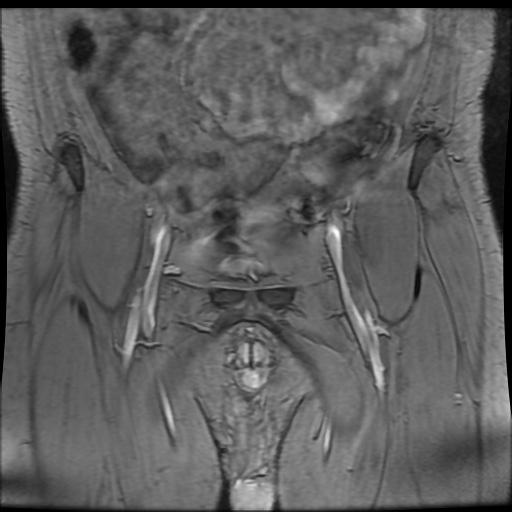 Avascular necrosis of the hip (Radiopaedia 61503-69465 F 5).jpg