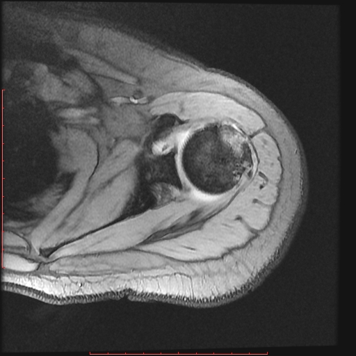 File:Avulsion fracture - greater tuberosity of humerus (Radiopaedia 25457-25703 Axial Gradient Echo 8).jpg