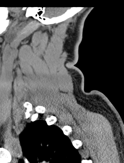 Axis peg fracture (type 3) and atlas lateral mass (type 4) fracture (Radiopaedia 37474-39324 D 64).png