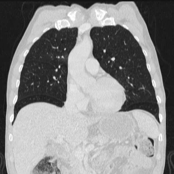 Azygos lobe (Radiopaedia 38259-40275 Coronal lung window 31).jpg