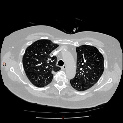 Azygos lobe (Radiopaedia 40161-42821 Axial lung window 20).jpg