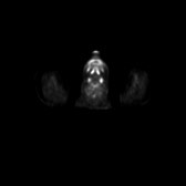 B-cell lymphoma of the mesentery (Radiopaedia 65743-74868 18F-FDG PET-CT 251).jpg