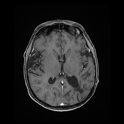 File:Balo concentric sclerosis (Radiopaedia 53875-59982 Axial LAVA C+ 141).jpg