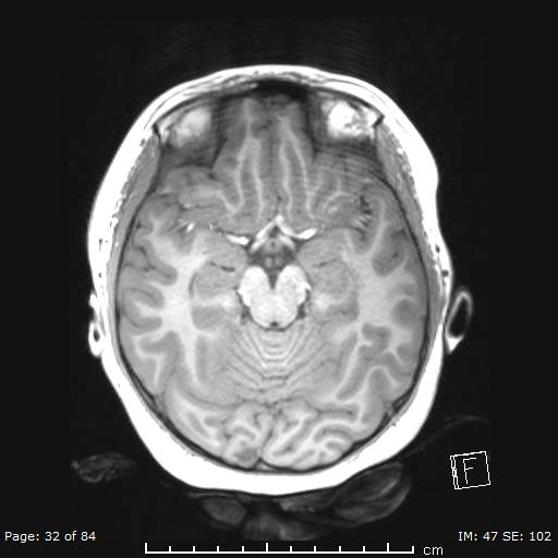 Balo concentric sclerosis (Radiopaedia 61637-69636 Axial T1 32).jpg