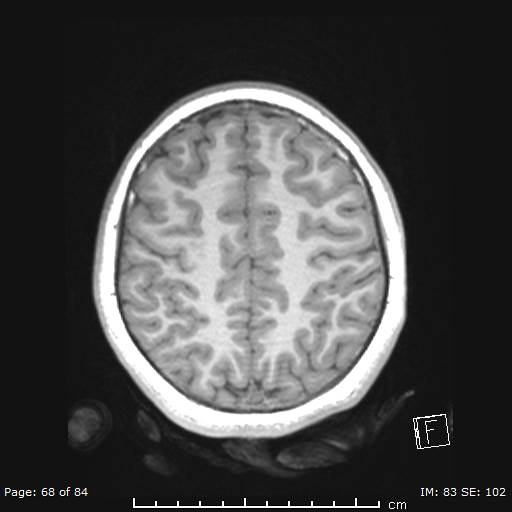 Balo concentric sclerosis (Radiopaedia 61637-69636 Axial T1 68).jpg