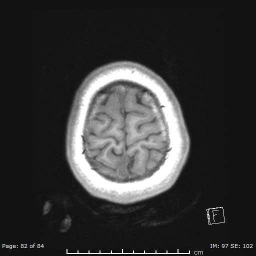 Balo concentric sclerosis (Radiopaedia 61637-69636 Axial T1 82).jpg
