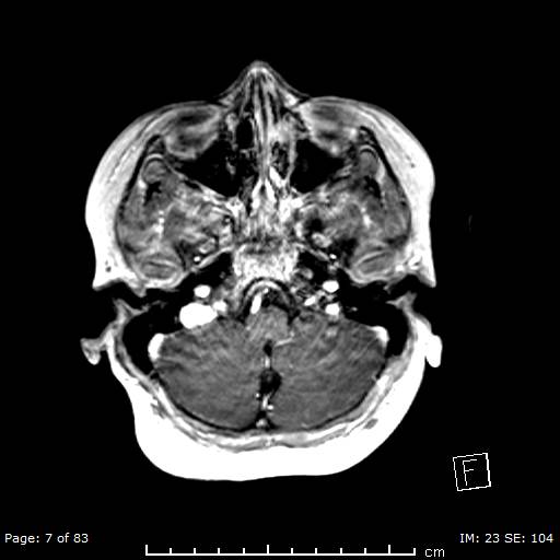 File:Balo concentric sclerosis (Radiopaedia 61637-69636 Axial T1 C+ 7).jpg