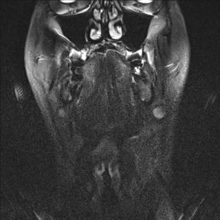 File:Base of tongue squamous cell carcinoma (Radiopaedia 31174-31884 Coronal T2 fat sat 18).jpg