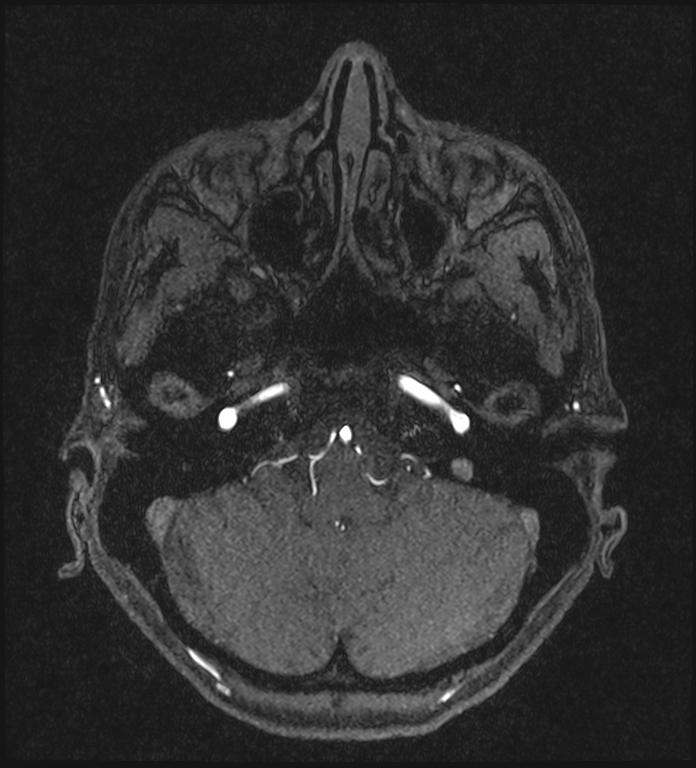 Basilar artery perforator aneurysm (Radiopaedia 82455-97733 Axial MRA 53).jpg