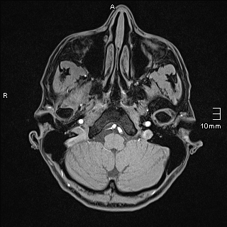 Basilar artery perforator aneurysm (Radiopaedia 82455-99523 F 12).jpg