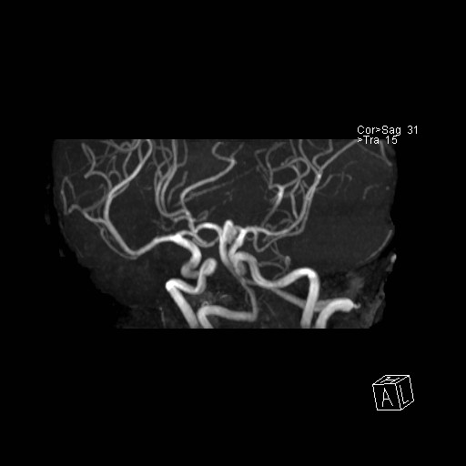 Basilar tip aneurysm (Radiopaedia 26504-26632 D 31).jpg