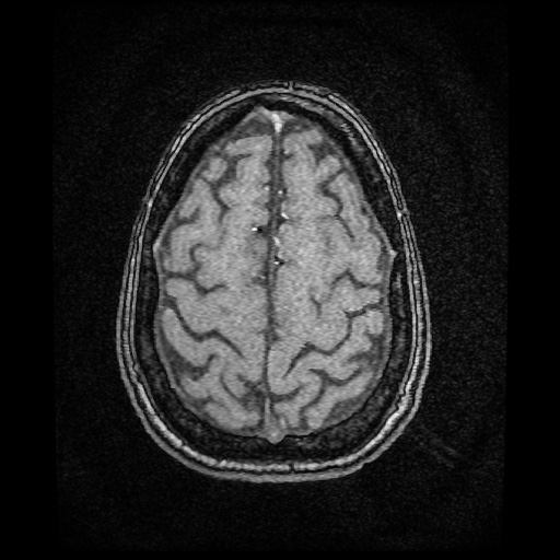 Basilar top and left middle cerebral artery aneurysm (Radiopaedia 61965-70031 Axial MRA 145).jpg