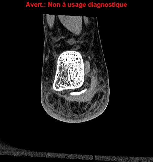 Baxter neuropathy (Radiopaedia 25988-26125 Coronal non-contrast 40).jpg