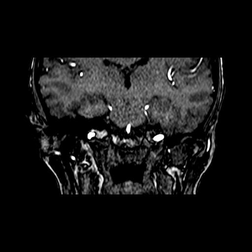 Berry aneurysm of the terminal internal carotid artery (Radiopaedia 88286-104918 Coronal TOF 55).jpg