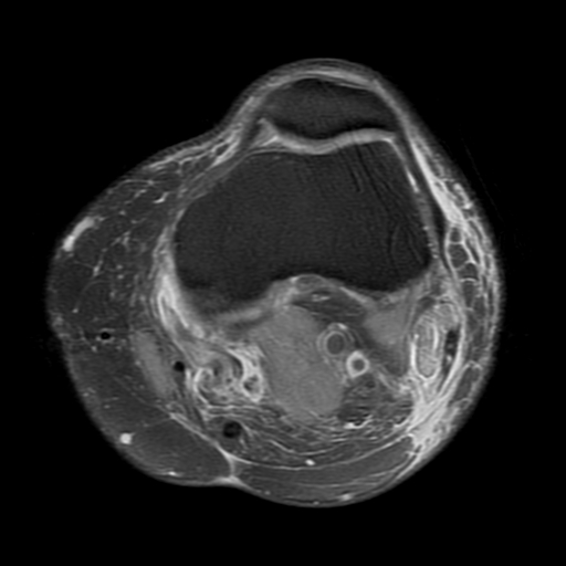 File:Biceps femoris distal tendon avulsion (Radiopaedia 15109-14987 Axial PD fat sat 8).jpg