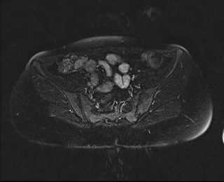 File:Bicornuate bicollis uterus (Radiopaedia 61626-69616 Axial PD fat sat 10).jpg