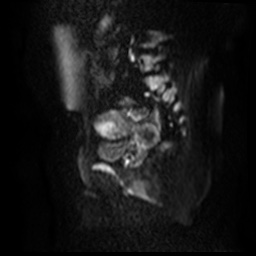 File:Bicornuate uterus (Radiopaedia 51676-57472 Sagittal DWI 42).jpg