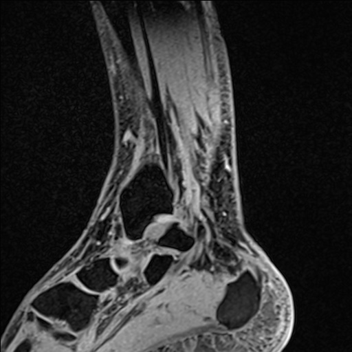 Bilateral Achilles tendon complete tear (Radiopaedia 81344-95051 Sagittal WE - Left 41).jpg