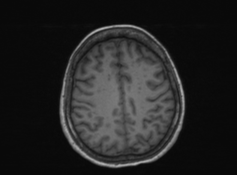 Bilateral PCA territory infarction - different ages (Radiopaedia 46200-51784 Axial T1 180).jpg