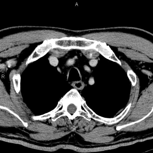 Bilateral Warthin tumors (Radiopaedia 84034-99263 Axial With contrast 70).jpg