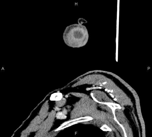 Bilateral Warthin tumors (Radiopaedia 84034-99263 D 10).jpg