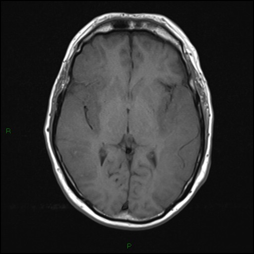 File:Bilateral acute middle cerebral artery territory infarcts (Radiopaedia 77319-89402 Axial T1 12).jpg