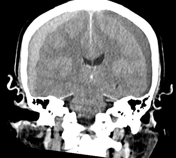 Bilateral acute on chronic subdural hematomas (Radiopaedia 78466-91146 Coronal non-contrast 41).jpg