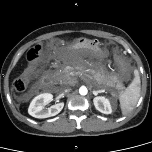 Bilateral adrenal gland hyperenhancement in pancreatitis (Radiopaedia 86642-102753 B 50).jpg