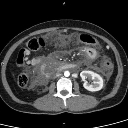 Bilateral adrenal gland hyperenhancement in pancreatitis (Radiopaedia 86642-102753 B 69).jpg