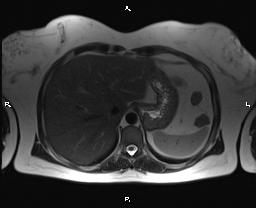 File:Bilateral adrenal myelolipoma (Radiopaedia 63058-71537 Axial T2 8).jpg