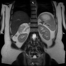 File:Bilateral adrenal myelolipoma (Radiopaedia 63058-71537 Coronal T2 8).jpg