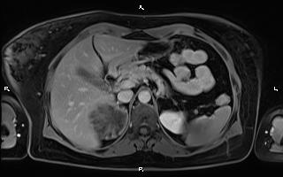 File:Bilateral adrenal myelolipoma (Radiopaedia 63058-71537 H 33).jpg