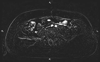 Bilateral adrenal myelolipoma (Radiopaedia 63058-71537 I 75).jpg