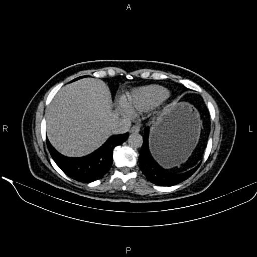 Bilateral benign adrenal adenomas (Radiopaedia 86912-103124 Axial non-contrast 18).jpg