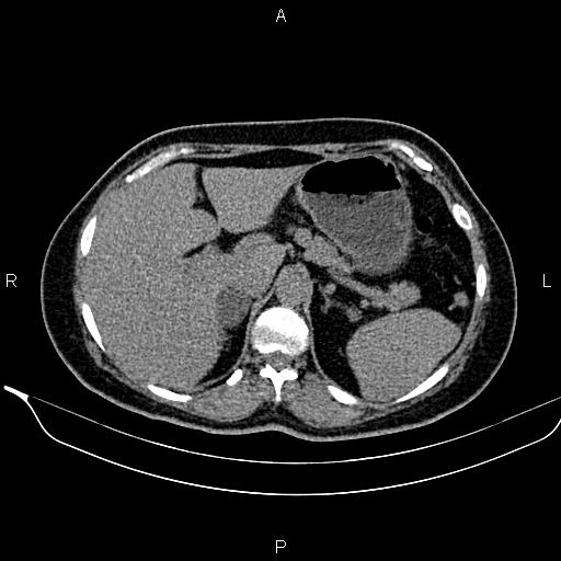 Bilateral benign adrenal adenomas (Radiopaedia 86912-103124 Axial non-contrast 32).jpg