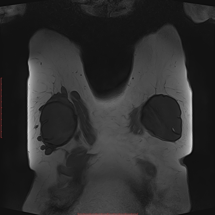Bilateral breast implant rupture (Radiopaedia 24761-25027 G 53).jpg