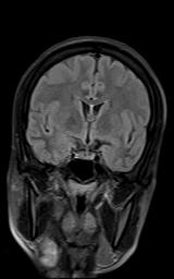 File:Bilateral carotid body tumors and right jugular paraganglioma (Radiopaedia 20024-20060 Coronal 59).jpg