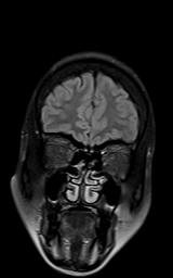 File:Bilateral carotid body tumors and right jugular paraganglioma (Radiopaedia 20024-20060 Coronal 75).jpg