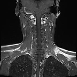 File:Bilateral carotid body tumors and right jugular paraganglioma (Radiopaedia 20024-20060 None 15).jpg