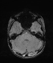 Bilateral mesial temporal polymicrogyria (Radiopaedia 76456-88181 Axial SWI 15).jpg