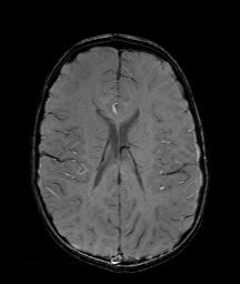 Bilateral mesial temporal polymicrogyria (Radiopaedia 76456-88181 Axial SWI 42).jpg