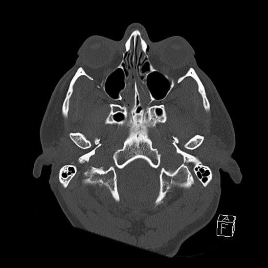 Bilateral occipital condyle fracture (type 2) (Radiopaedia 87675-104089 Axial bone window 15).jpg