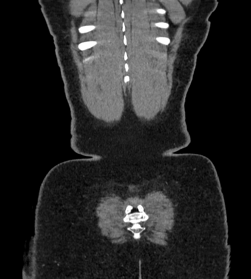 Bilateral ovarian mature cystic teratomas (Radiopaedia 79373-92457 B 107).jpg