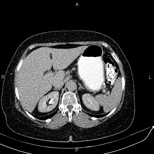 File:Bilateral ovarian serous cystadenocarcinoma (Radiopaedia 86062-101989 Axial C+ delayed 10).jpg