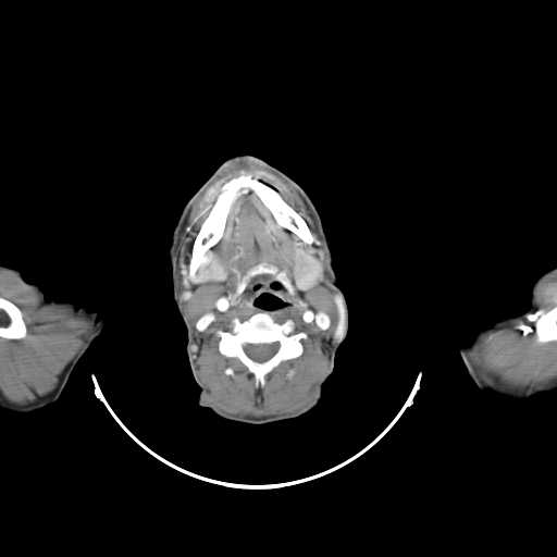 Bilateral parotid gland lymphoma (Radiopaedia 21038-20969 A 14).jpg