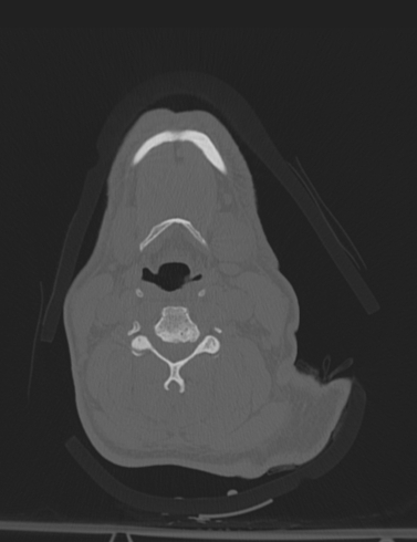 File:Bilateral perched facet joint (Radiopaedia 63149-71669 Axial bone window 30).jpg
