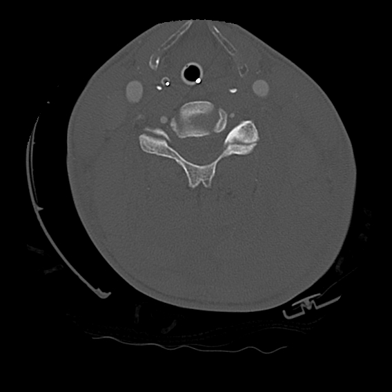 Bilateral perched facets with cord injury (Radiopaedia 45587-49713 Axial bone window 61).jpg