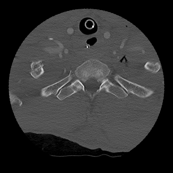 File:Bilateral perched facets with cord injury (Radiopaedia 45587-49713 Axial bone window 99).jpg